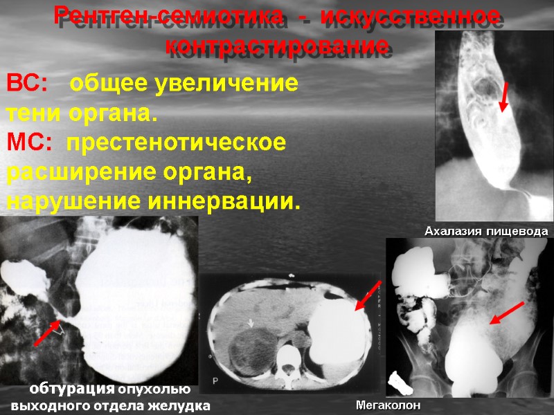 Рентген-семиотика  -  искусственное контрастирование ВС:   общее увеличение тени органа. МС: